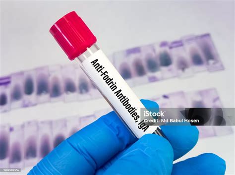 test for sjogren's antibodies